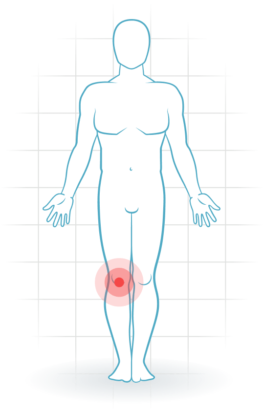 pijnlocatie Degeneratief meniscus letsel