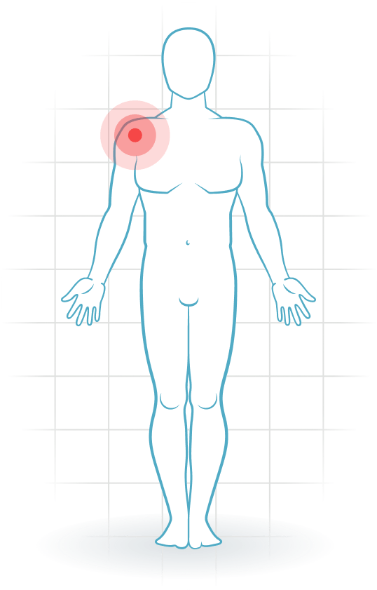 pijnlocatie Schouderartrose