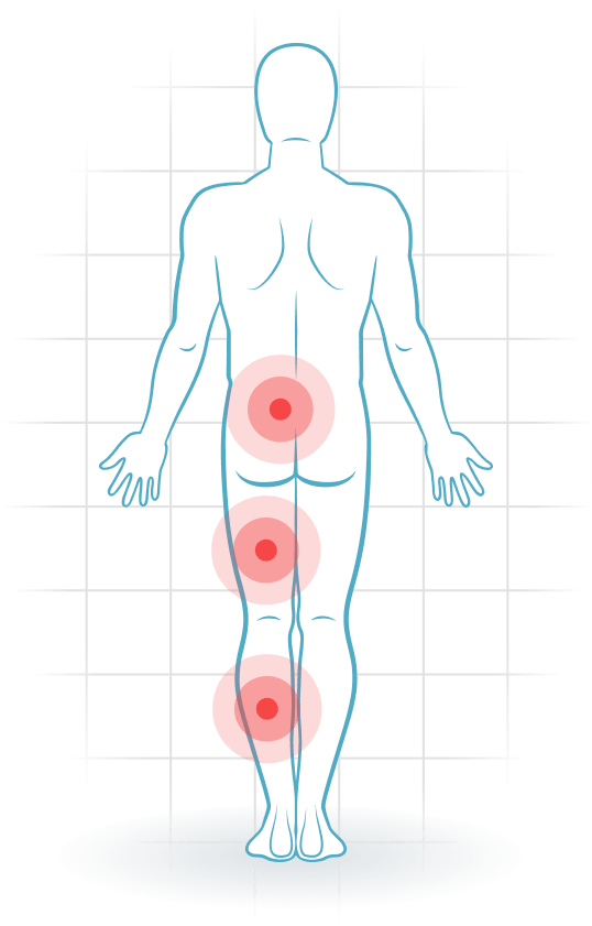 pijnlocatie Lumbosacraal radiculair syndroom (hernia)