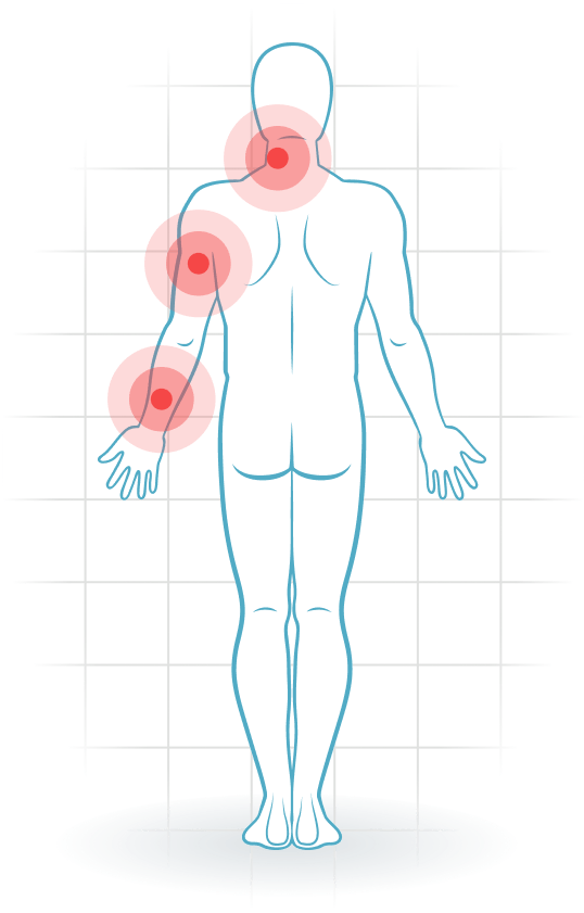 pijnlocatie Cervicale radiculopathie