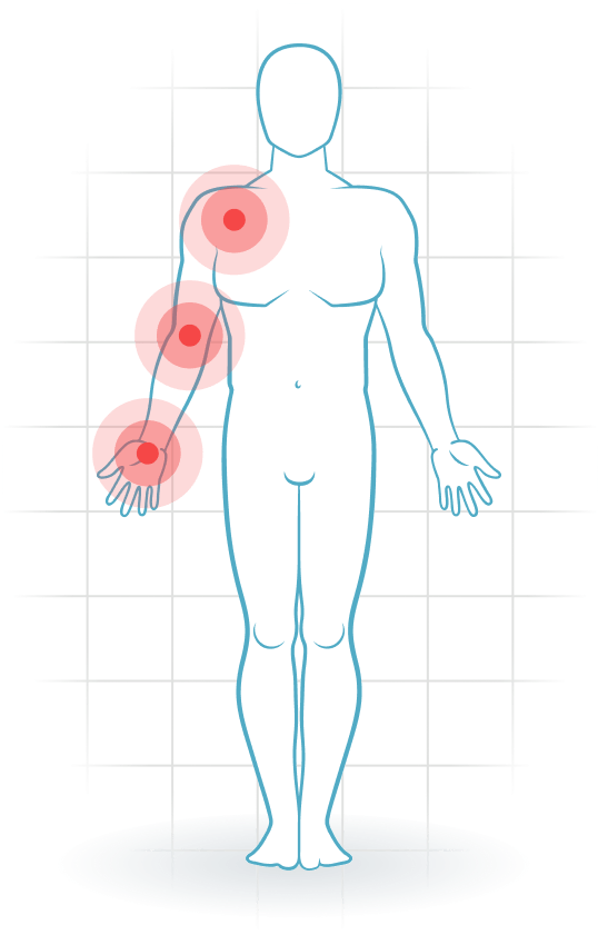 pijnlocatie Thoracic-outlet syndroom