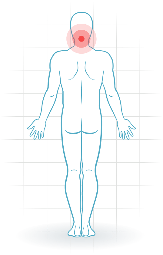 pijnlocatie Cervicaal facetsyndroom