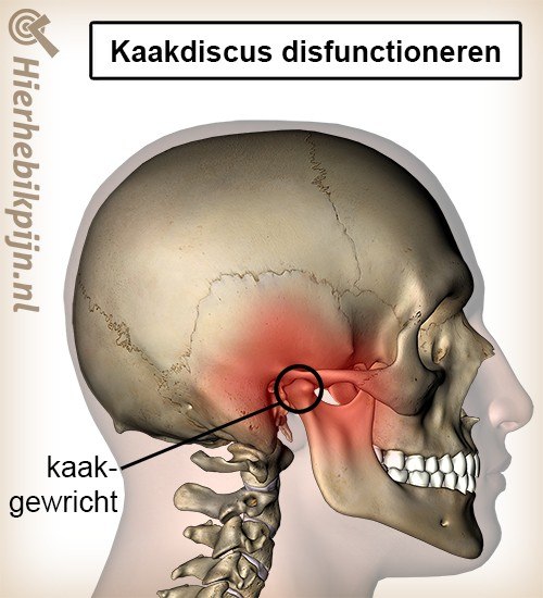 hoofd kaak kaakdiscus disfunctioneren kaakgewricht