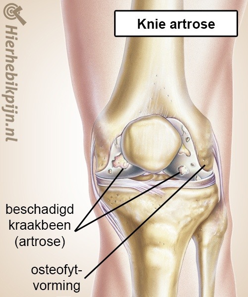 knie artrose slijtage kraakbeen