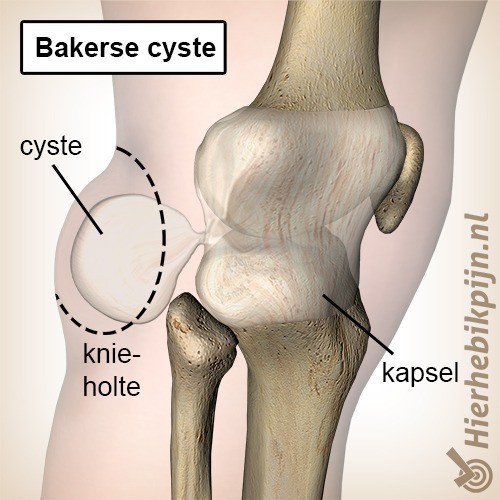 knie bakerse cyste popliteale cyste