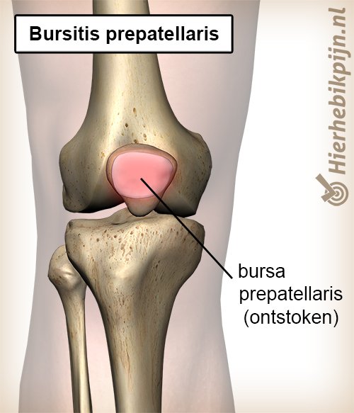 knie bursitis prepatellaris bursa ontstoken slijmbeurs knieschijf