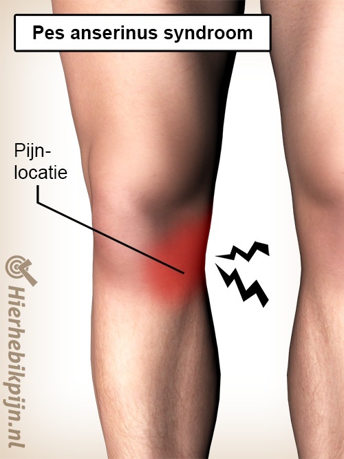 knie pes anserinus syndroom pijn locatie