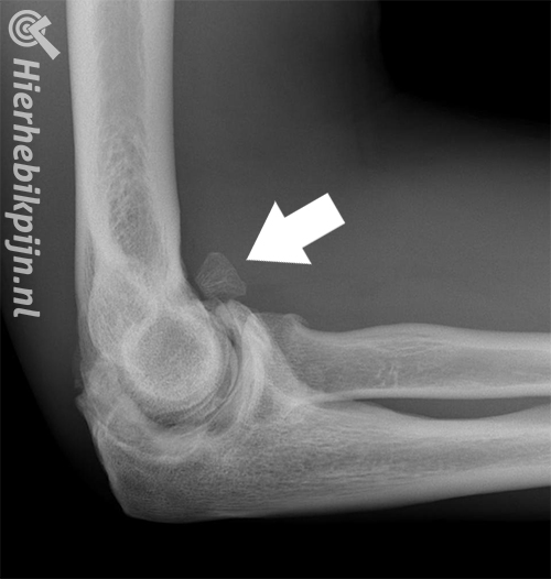 myositis ossificans arm
