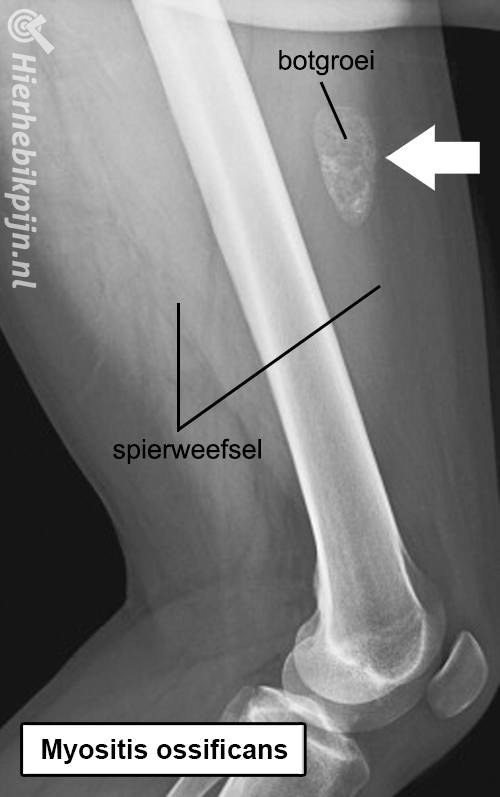 myositis ossificans rontgenfoto anatomie