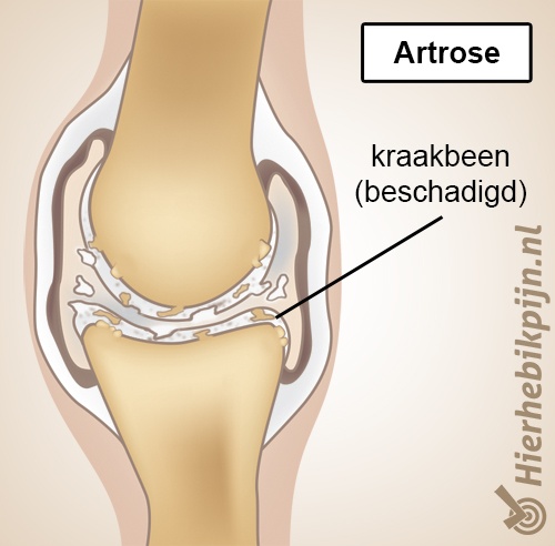 artrose anatomie versleten