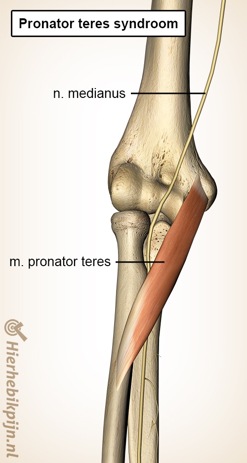 onderarm pronator teres spier medianus zenuw syndroom
