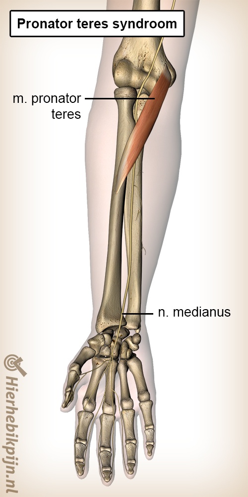 onderarm pronator teres syndroom spier nervus medianus zenuw