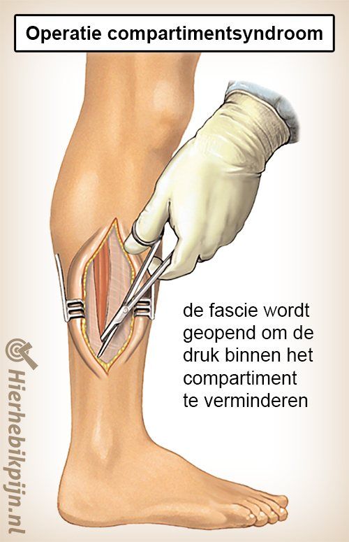 onderbeen compartimentsyndroom operatie