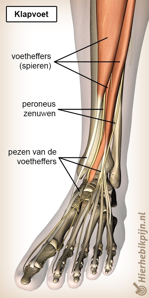 onderbeen klaptvoet peroneus zenuwen voetheffers spieren pezen