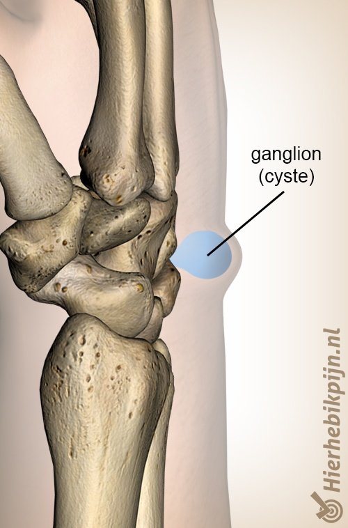 pols ganglion cyste anatomie