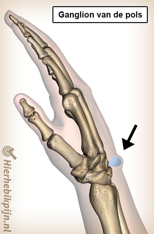 pols ganglion zwelling bult anatomie slijmcyste mucoid cyste