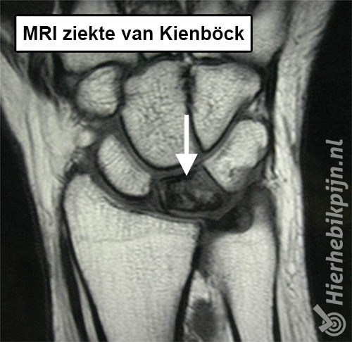 pols ziekte van kienbock mri os lunatum