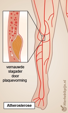 been etalagebenen claudicatio intermittens plaquevorming