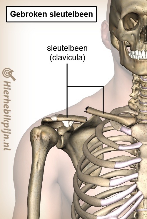 schouder clavicula fractuur gebroken sleutelbeen