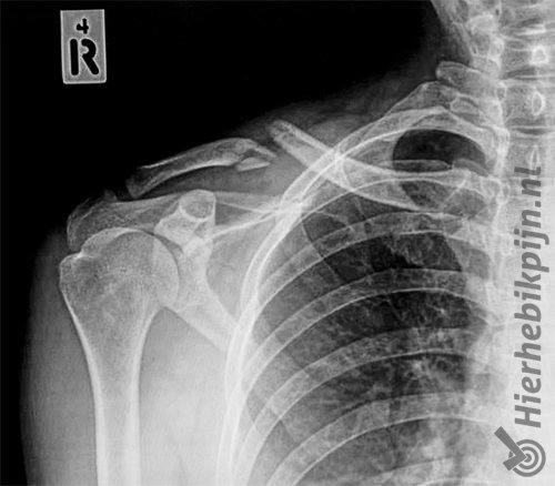 schouder clavicula fractuur sleutelbeenbreuk rontgen