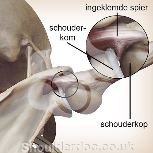 schouder intern impingement schouderkop schouderkom zoom inklemming