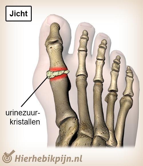 teen jicht urinezuurkristallen