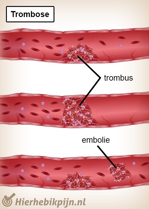 trombose trombus embolie bloedvat ader slagader