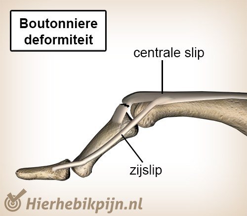 vinger boutonniere deformiteit strekpees zijslip centrale slip