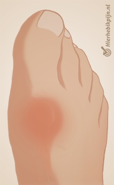 voet hallux rigidus foto