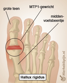 voet hallux rigidus grote teen mtp1 gewricht