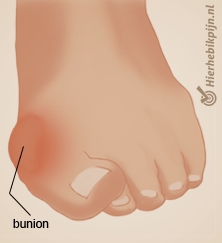 voet hallux valgus bunion