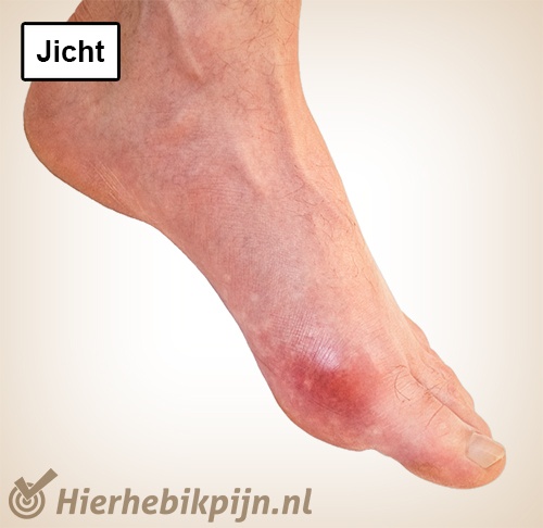 voet jicht teen rood zwelling jichtknobbels tophi