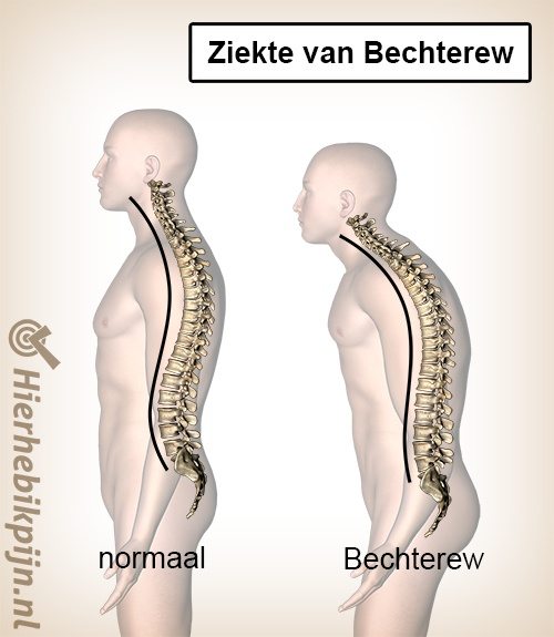 ziekte van bechterew kyfose bolle rug