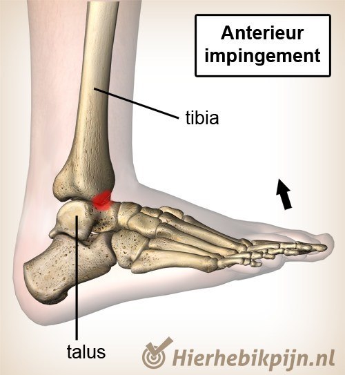 enkel anterior impingement dorsaal flexie
