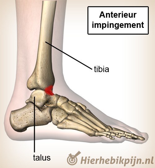 enkel anterior impingement
