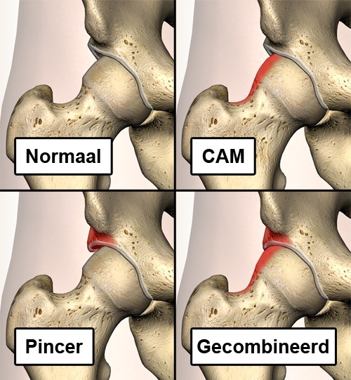 heup impingement fai types