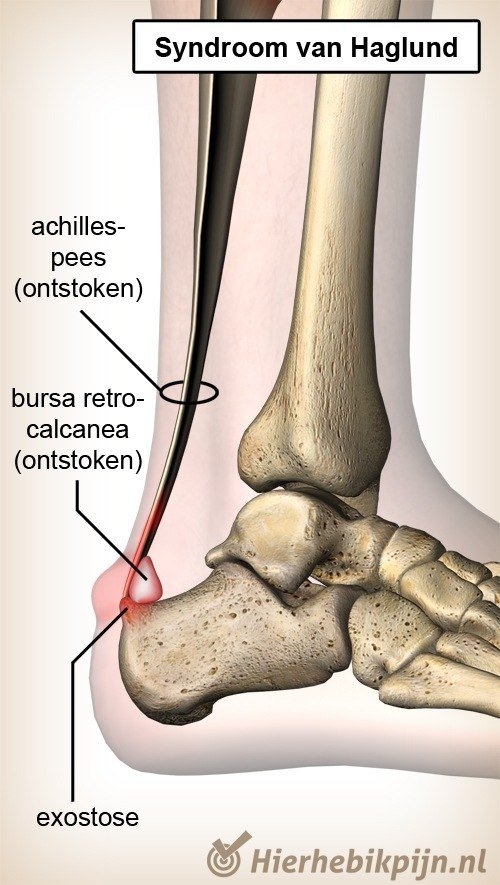 enkel haglund syndroom achillespees bursa retrocalcanea hielbeen calcaneus
