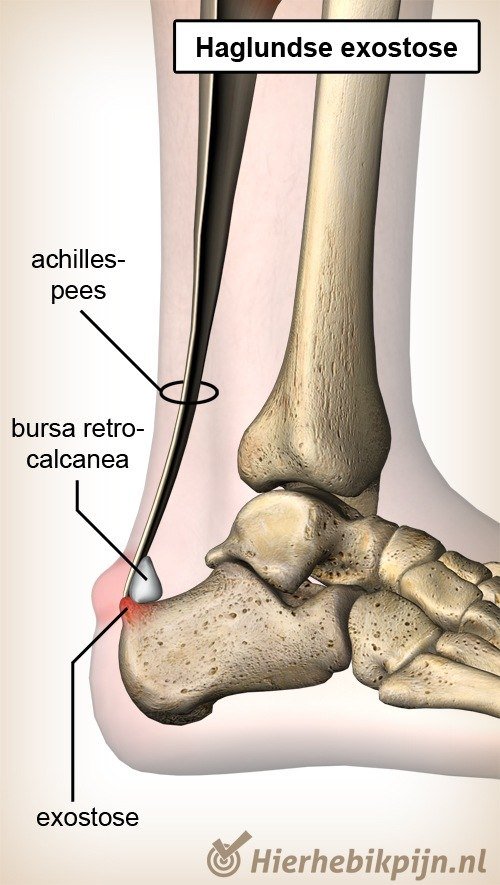 enkel haglundse exostose deformiteit achillespees bursa retrocalcanea hielbeen calcaneus