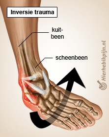 enkel inversie trauma anatomie enkelbanden