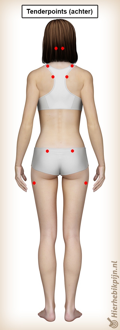 fibromyalgie tenderpoints achter