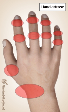 hand artrose pijn locaties