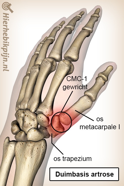 hand duim duimbasis artrose os trapezium middenhandsbeentje metacarpale I CMC 1 gewricht