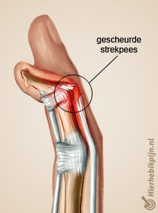 hand mallet finger anatomie