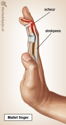 hand mallet finger