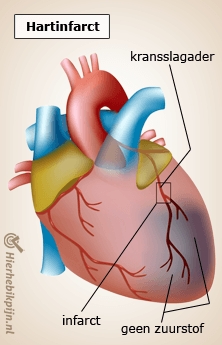 hart hartinfarct kransslagader anatomie