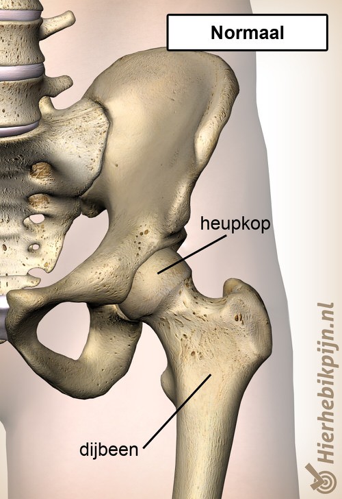 heup epifysiolysis capitis femoris normaal