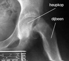 heup epifysiolysis capitis femoris rontgen
