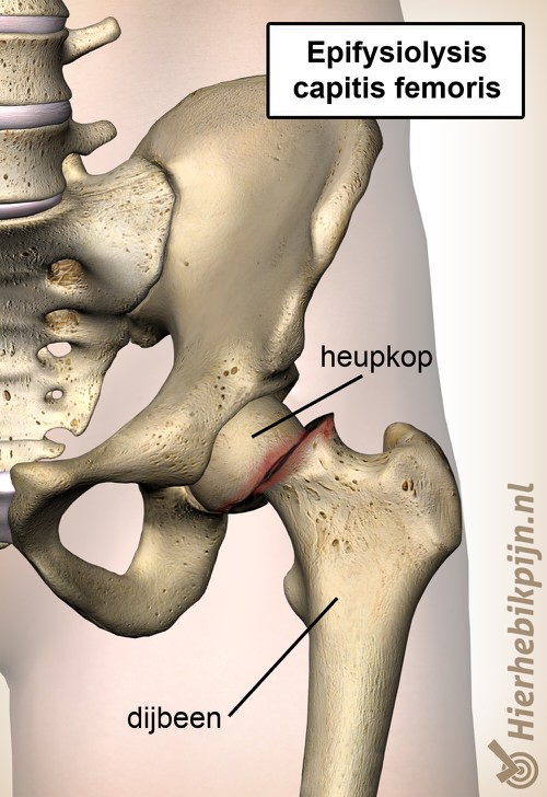 heup epifysiolysis capitis femoris