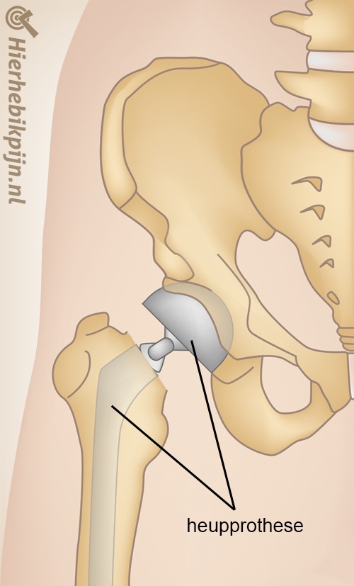 heup heupfractuur prothese