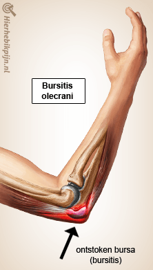 arm bursitis olecrani anatomie